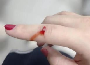 蹭破皮怎么止血最快/蹭破止血最简单的方法